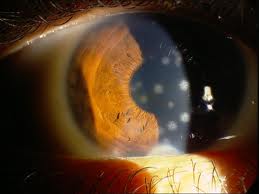 Superficial punctate keratitis | Eve's Optometry Blog